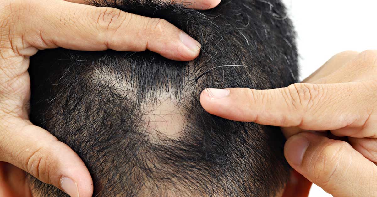 What is alopecia areata?
