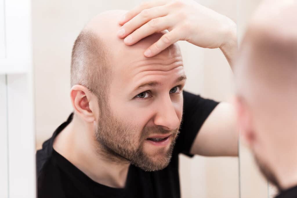 is-my-hair-loss-permanent-austin-hair-restoration-clinic