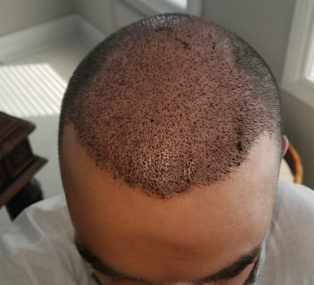 Austin - Hair Transplant After 1 Month