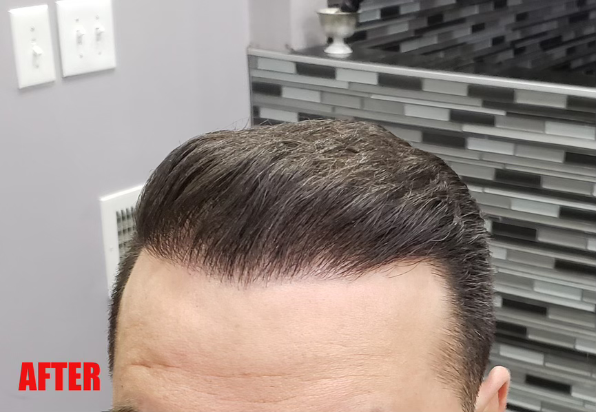 Hair Transplant After 9-12 Months