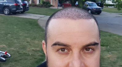 Hair Transplant After 3 Months