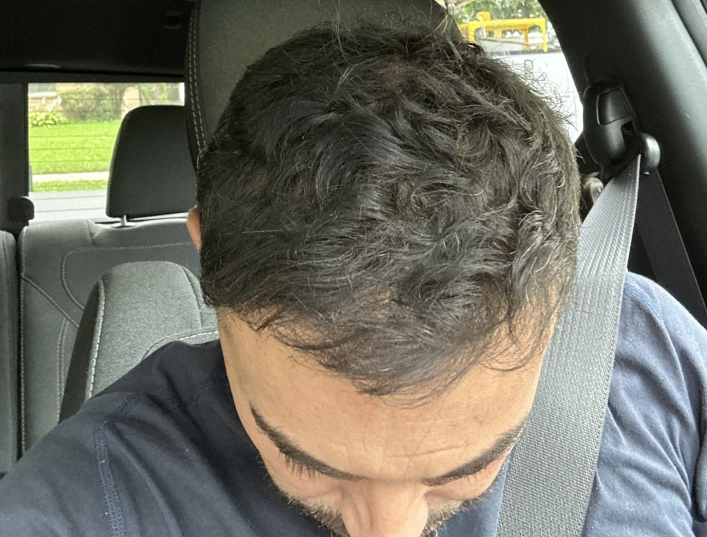 Hair Transplant After 9-12 Months